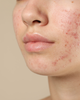 Acne is a Mask
